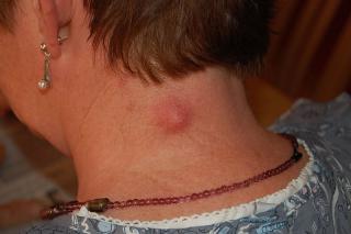cyst image cyst image