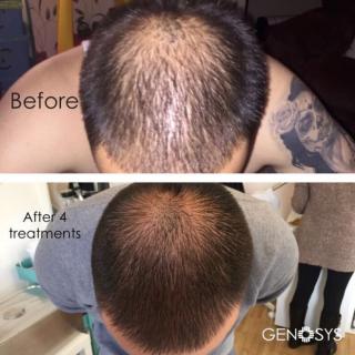 hair loss treatment hair loss treatment