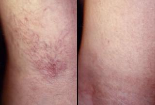 thread vein before after thread vein before after