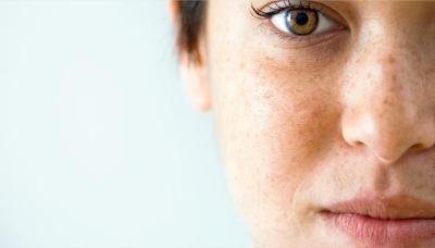 hyper pigmentation advice