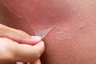skin peeling