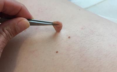 a skin tag before treatment