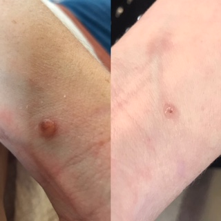 mole removal