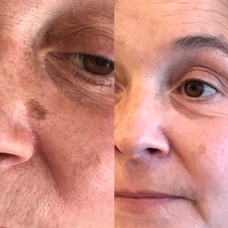 face pigmentation