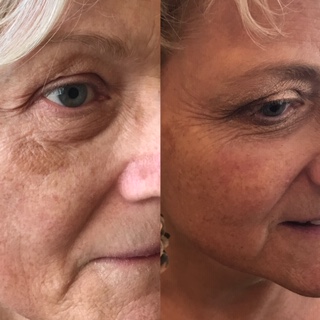 sun damage face