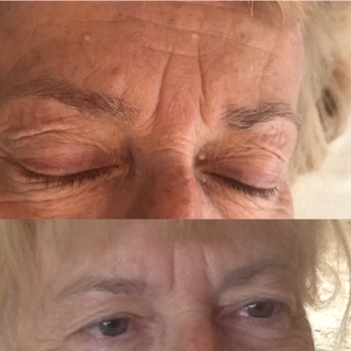 milia before and after