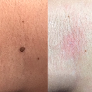 skin tag removal