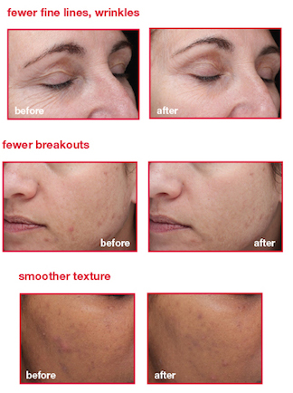 acne treatment