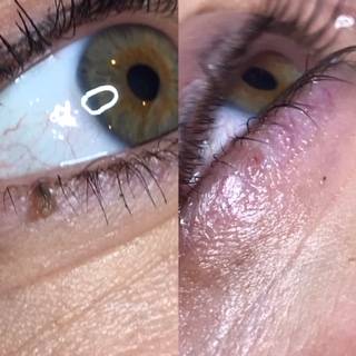 eye skin tag removal
