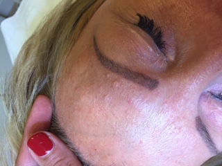 sebaceous hyperplasia on the forehead