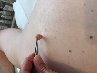 skin tag removal