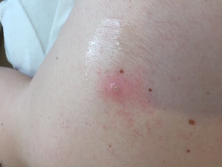 skin tag after treatment