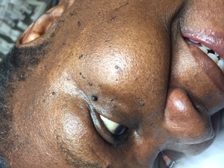 papulosa nigra treatment - before