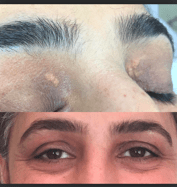 Xanthelasma treatment
