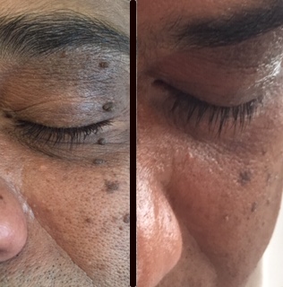 dermatosis nigra before and after treatment