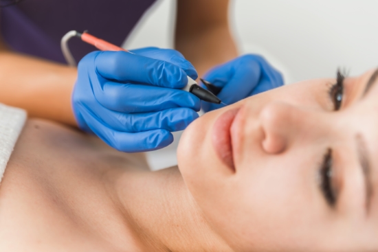 hair removal by electrolysis