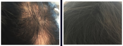 hair loss treatment