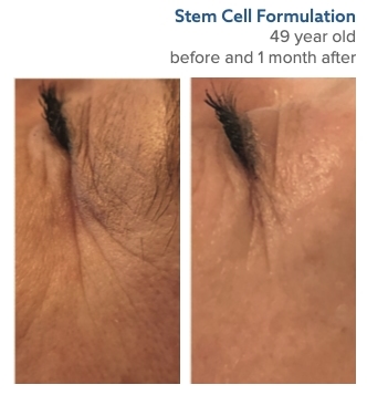 stem cell micro needling treatment