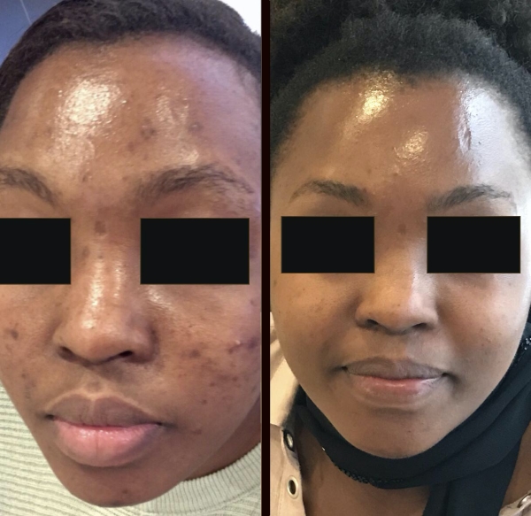 pigmentation treatment