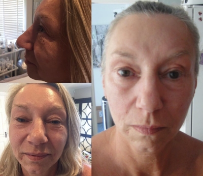 plasma shower treatment