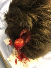 sebaceous cyst treatment