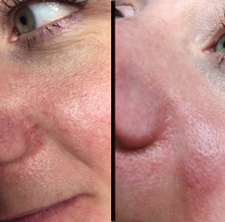 facial thread veins