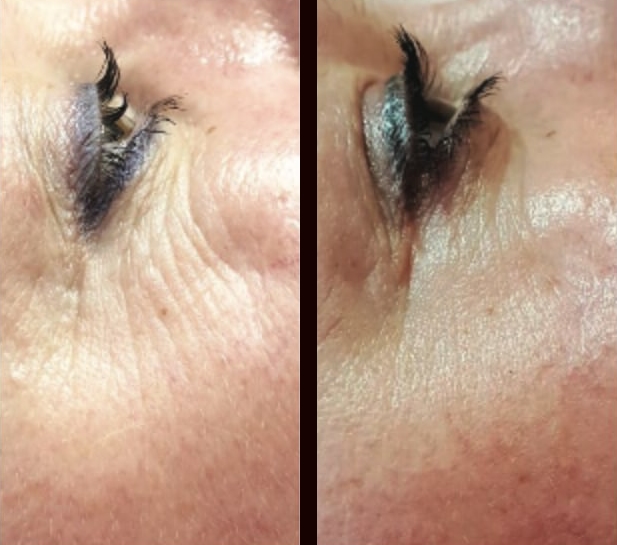 wrinkled skin treatment